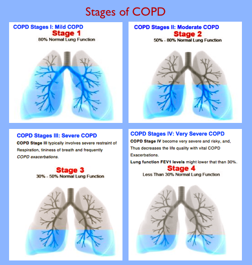 Four stages of COPD