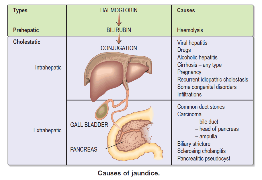 Causes of jaundice