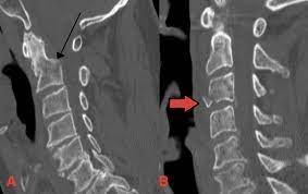 C-spine fracture on CT