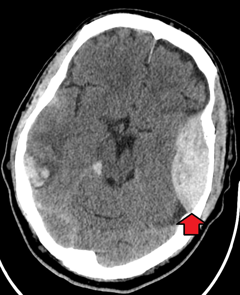 Epidural haemorrhage