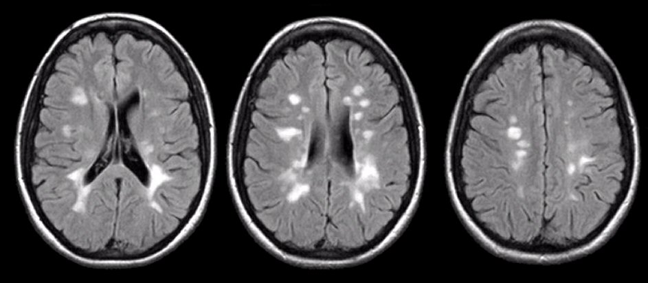 Multiple sclerosis plaque