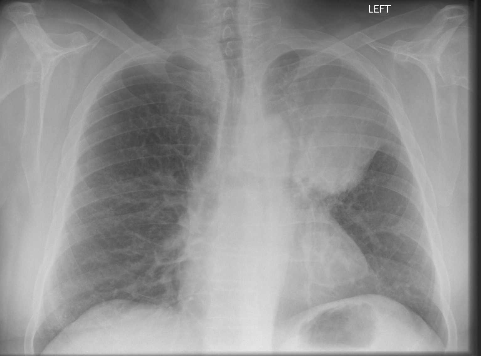 Non–small cell lung cancer