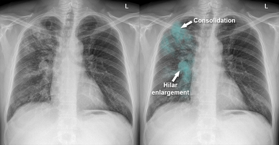 Pulmonary TB