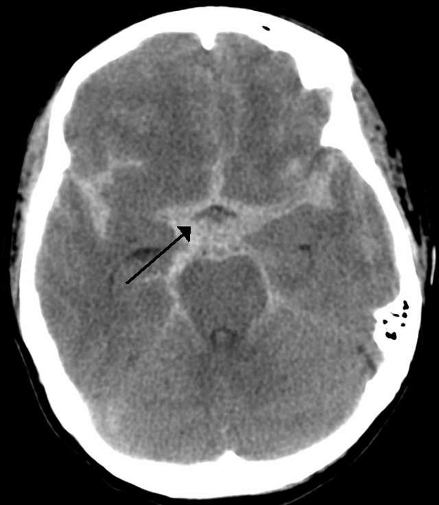 Diffuse subarachnoid haemorrhage