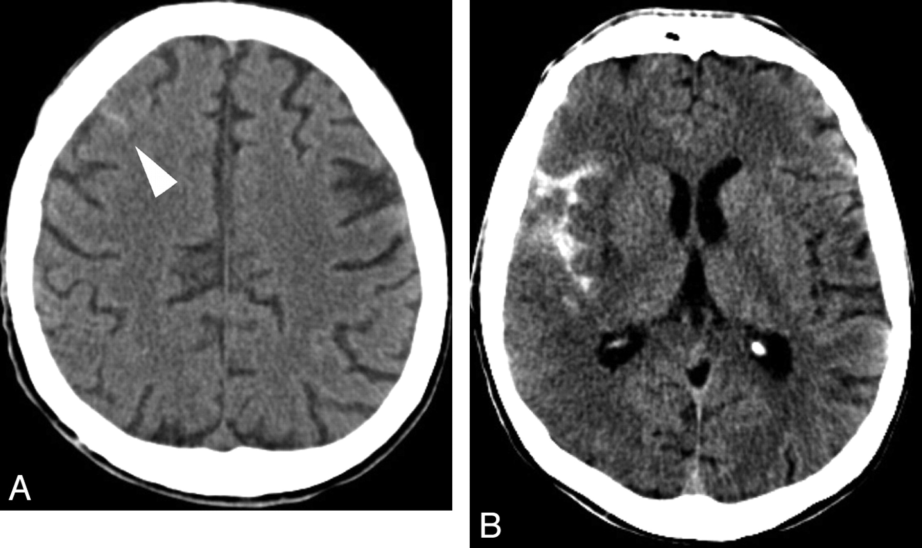 Localised subarachnoid haemorrhage