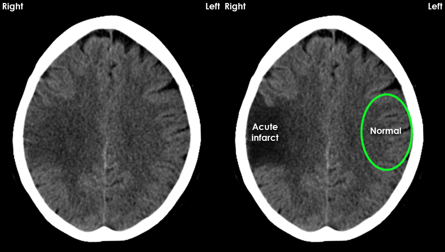 Acute intracranial infarct