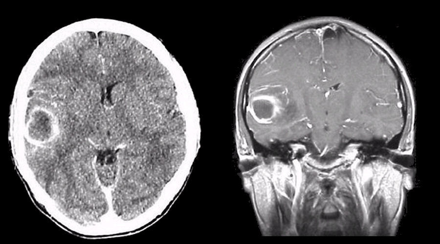 CT of brain abscess