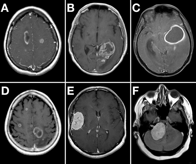 CT of brain tumour