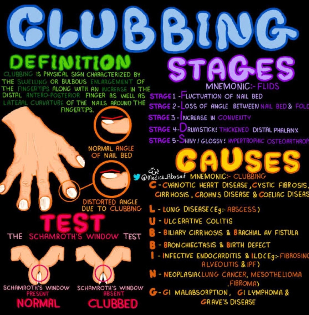 Clubbing example 2