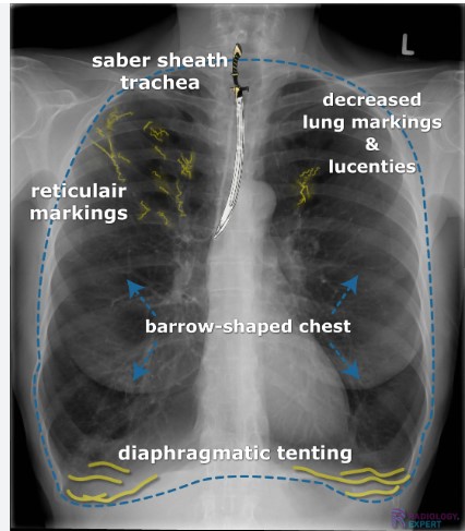 Typical COPD findings on chest X-ray