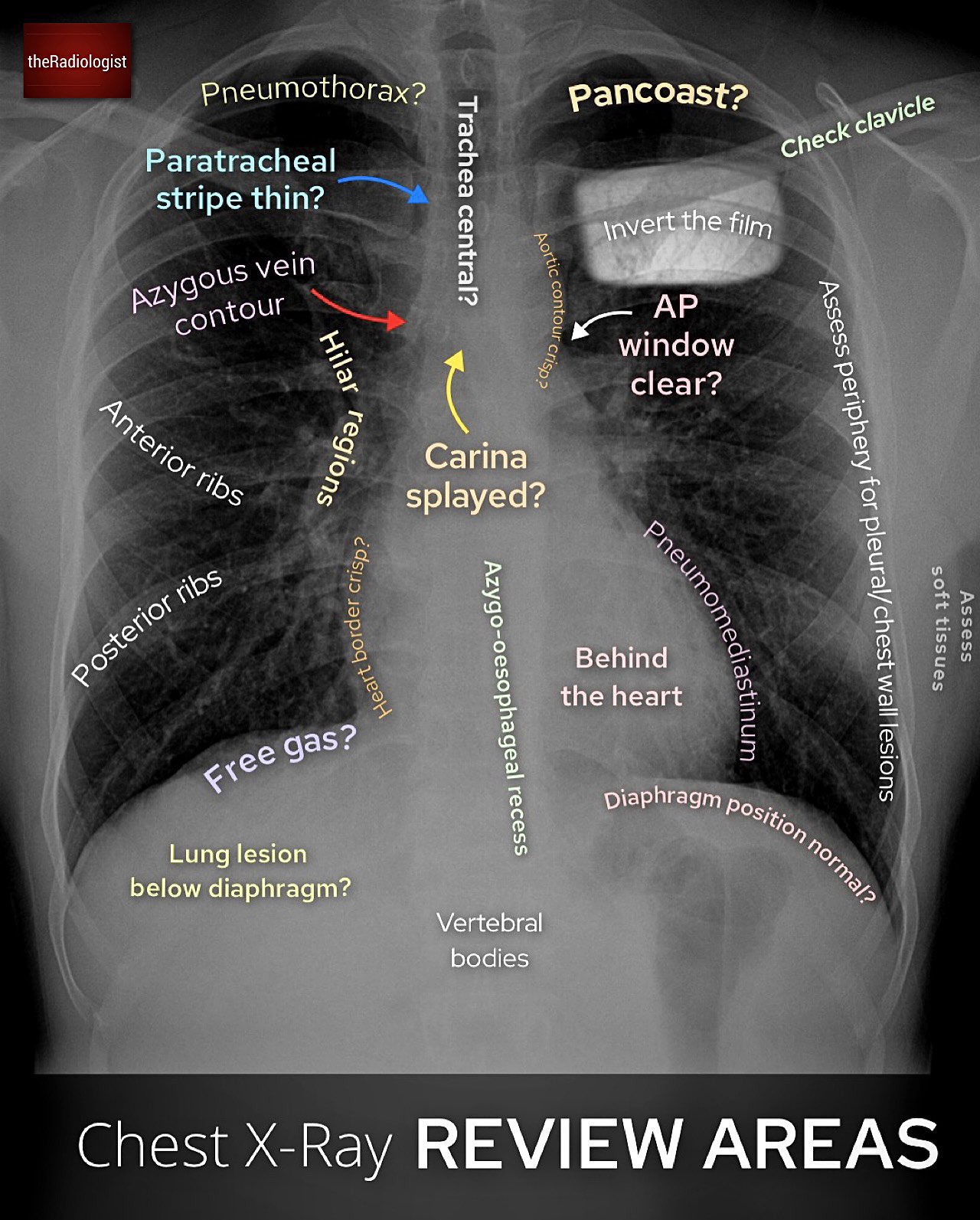 Checklist of areas to review on a chest X-ray