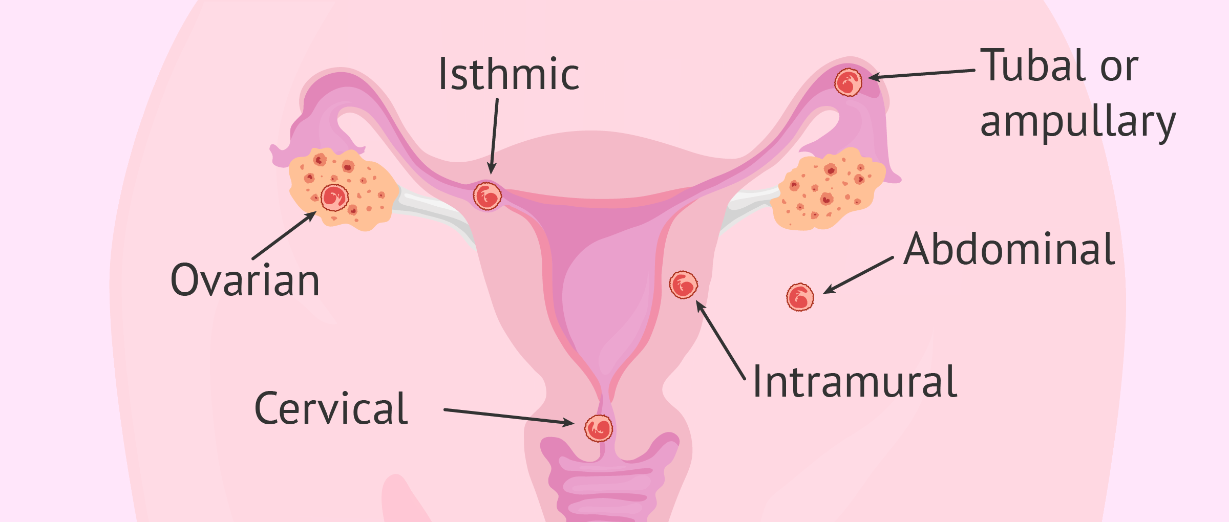 Types of Ectopic Pregnancies