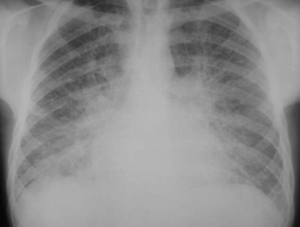 Typical features of CCF on chest X-ray