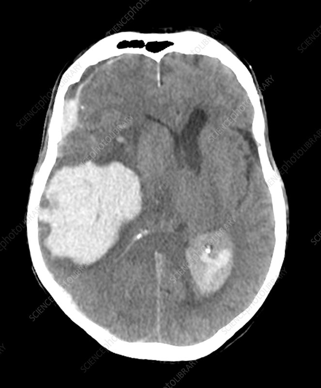 Intra-cranial haemorrhage