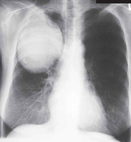 Large cell carcinoma of the lung