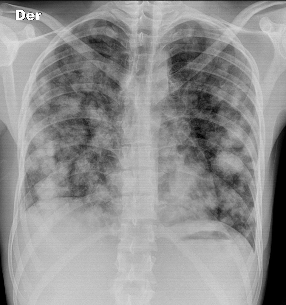 Pulmonary metastases