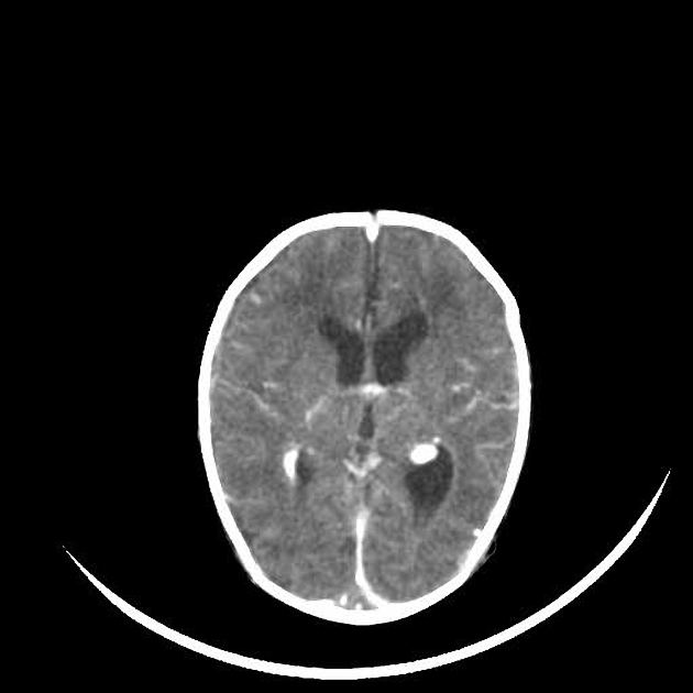 CT of meningitis