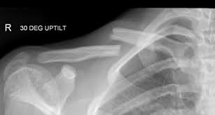 Clavicle Fracture