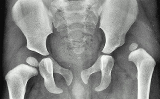 Developmental Dysplasia of the Hip (DDH)