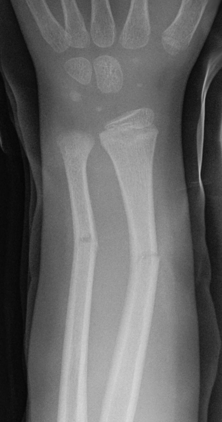 Greenstick Fracture