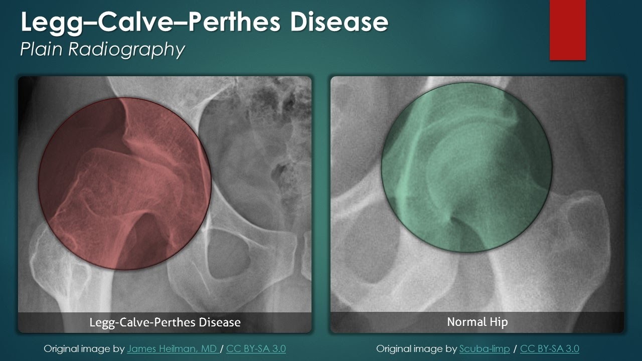 Legg-Calvé-Perthes Disease