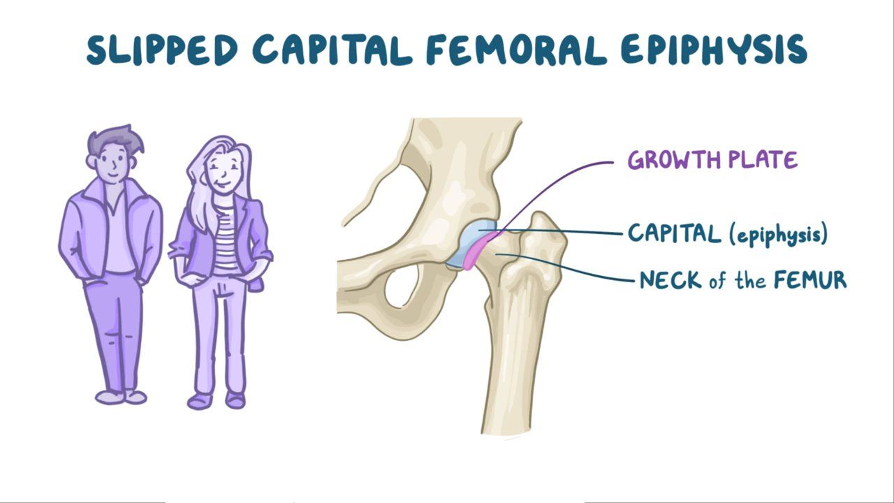 Slipped Upper/Capital Femoral Epiphysis