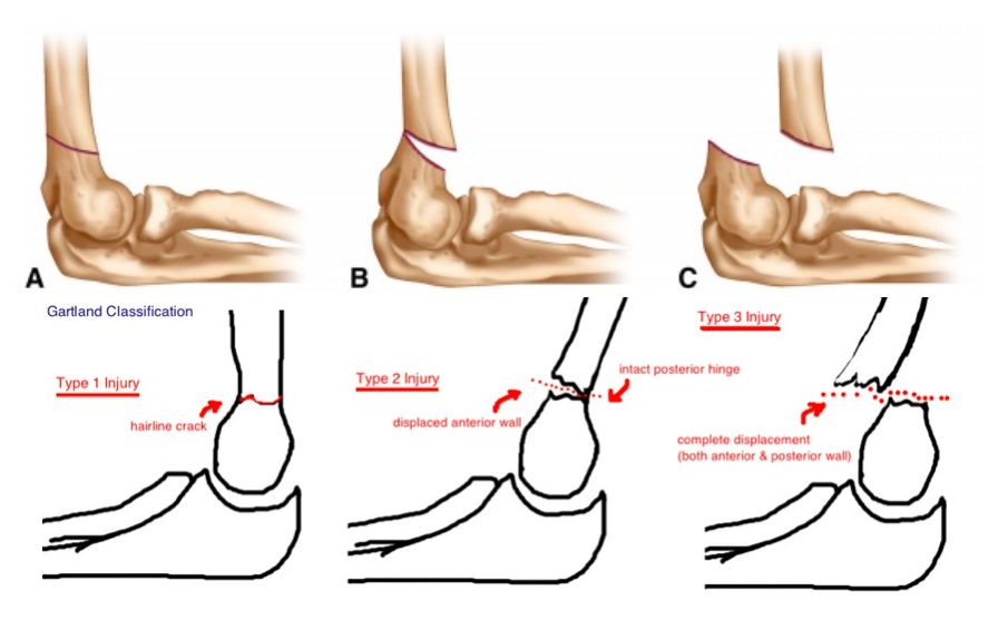 Supracondylar Fractures