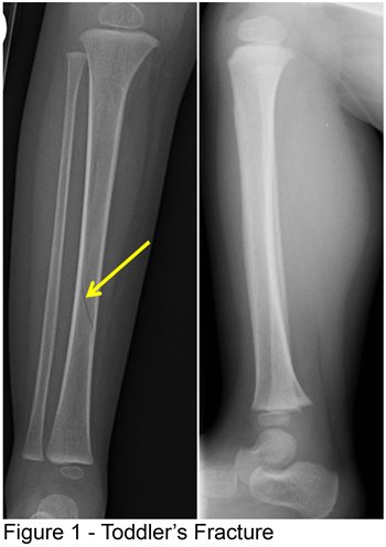 Toddler's Fracture