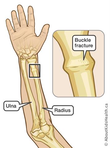 Torus/Buckle Fracture