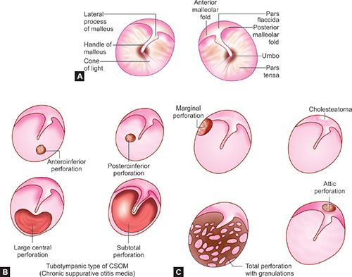 Perforated Tympanic Membrane