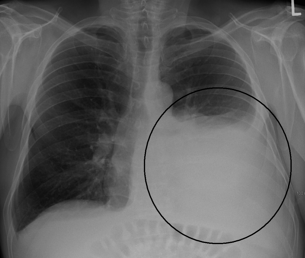 Left-sided pleural effusion