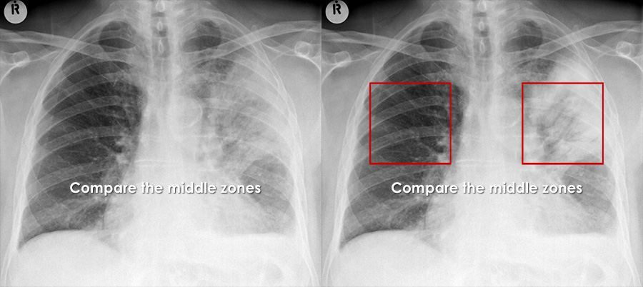 Left middle lobe pneumonia versus normal lung