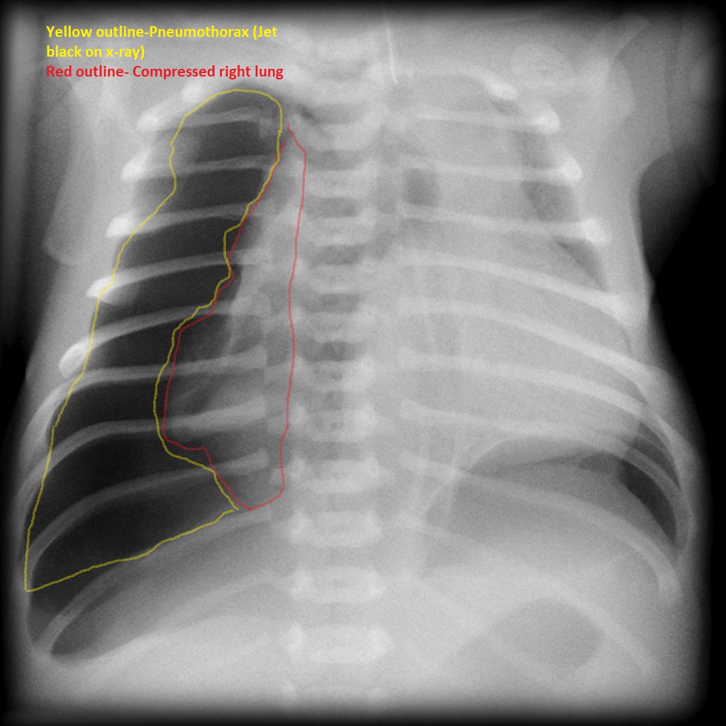 Right-sided pneumothorax