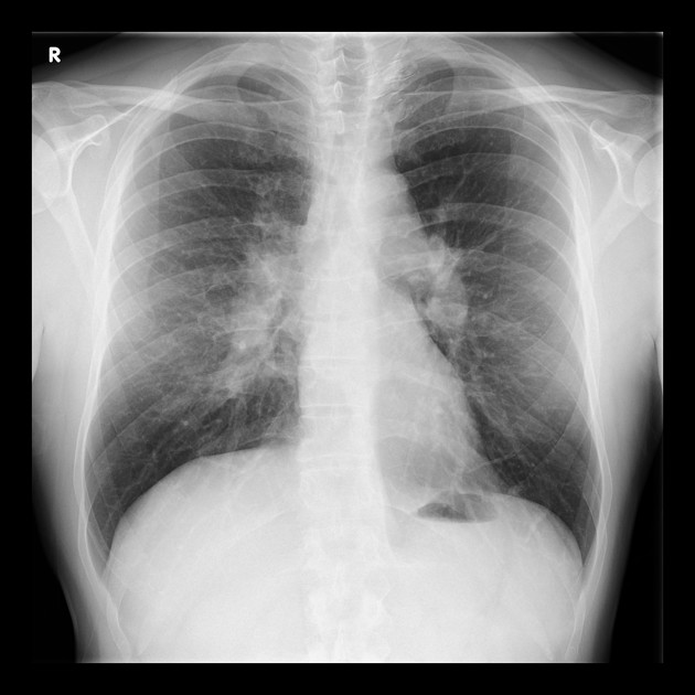 Small cell lung cancer