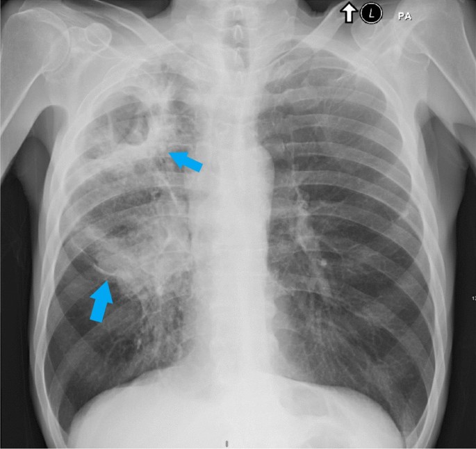 Squamous cell carcinoma of the lung