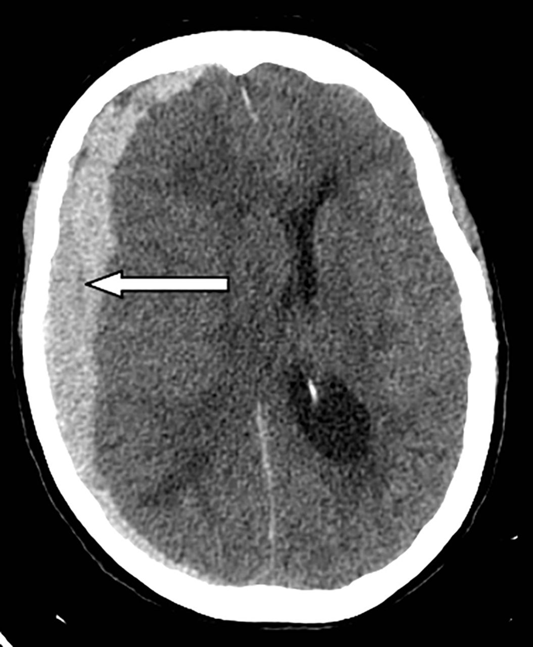 Subdural haemorrhage