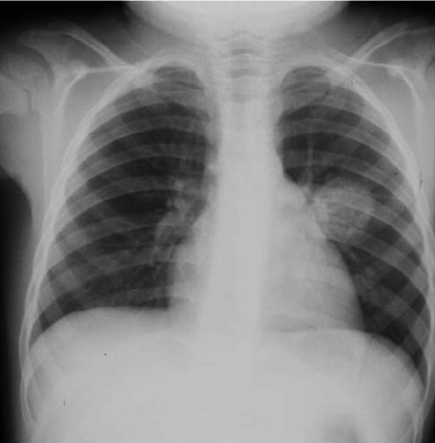 Ghon complex on X-ray