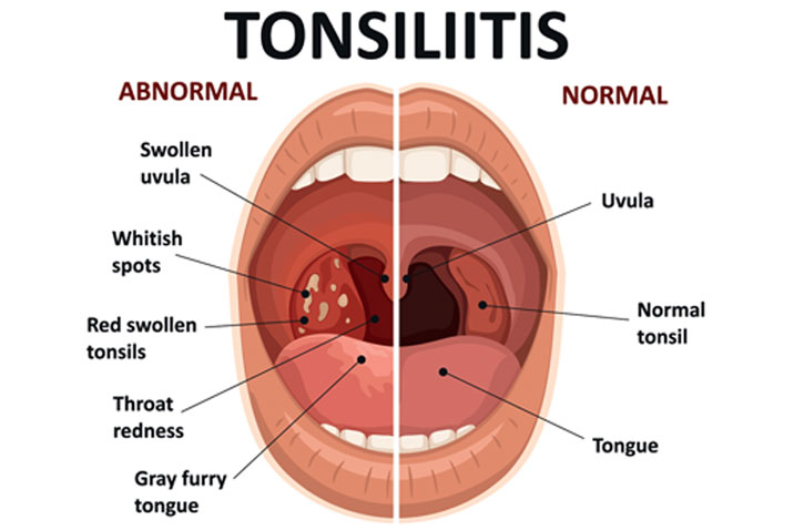 Tonsillitis